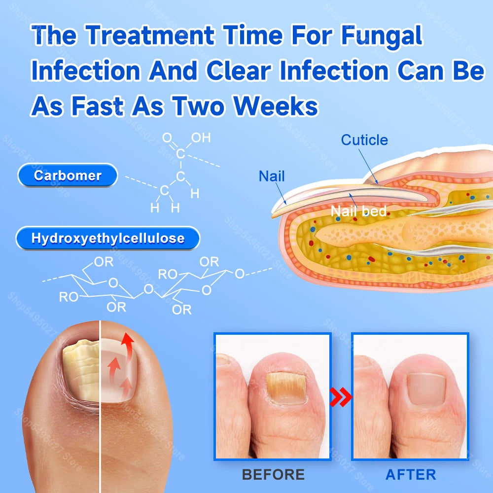 Uñas de los pies Tratamiento de hongos en las uñas Reparación de uñas de los dedos Dispositivo de uñas de los pies Tratamiento de hongos en las uñas de los pies Aceite esencial Onicomicosis Cuidado