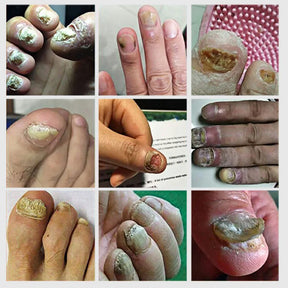 Uñas de los pies Tratamiento de hongos en las uñas Reparación de uñas de los dedos Dispositivo de uñas de los pies Tratamiento de hongos en las uñas de los pies Aceite esencial Onicomicosis Cuidado