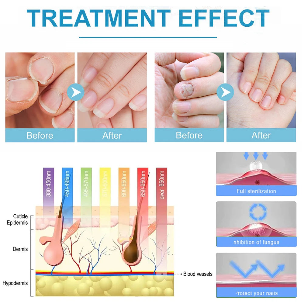 Uñas de los pies Tratamiento de hongos en las uñas Reparación de uñas de los dedos Dispositivo de uñas de los pies Tratamiento de hongos en las uñas de los pies Aceite esencial Onicomicosis Cuidado